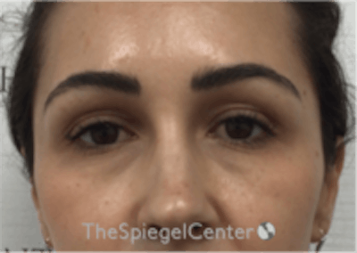 Temple Filler Before & After Gallery - Patient 157140577 - Image 2