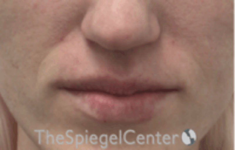 Nasolabial Fold Filler Before & After Gallery - Patient 157140585 - Image 2