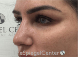 Upper Eyelid Filler Before & After Gallery - Patient 157140578 - Image 4