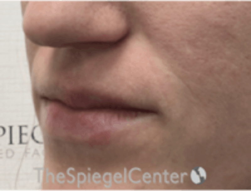 Lip Filler Before & After Gallery - Patient 157140582 - Image 5