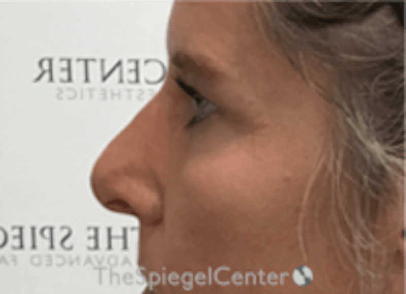 Non-Surgical Rhinoplasty / Nose Filler Before & After Gallery - Patient 157140580 - Image 4