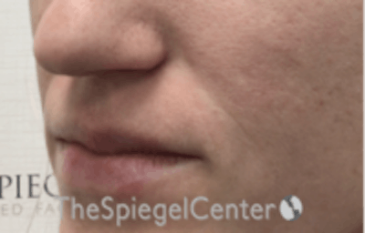 Nasolabial Fold Filler Before & After Gallery - Patient 157140585 - Image 3