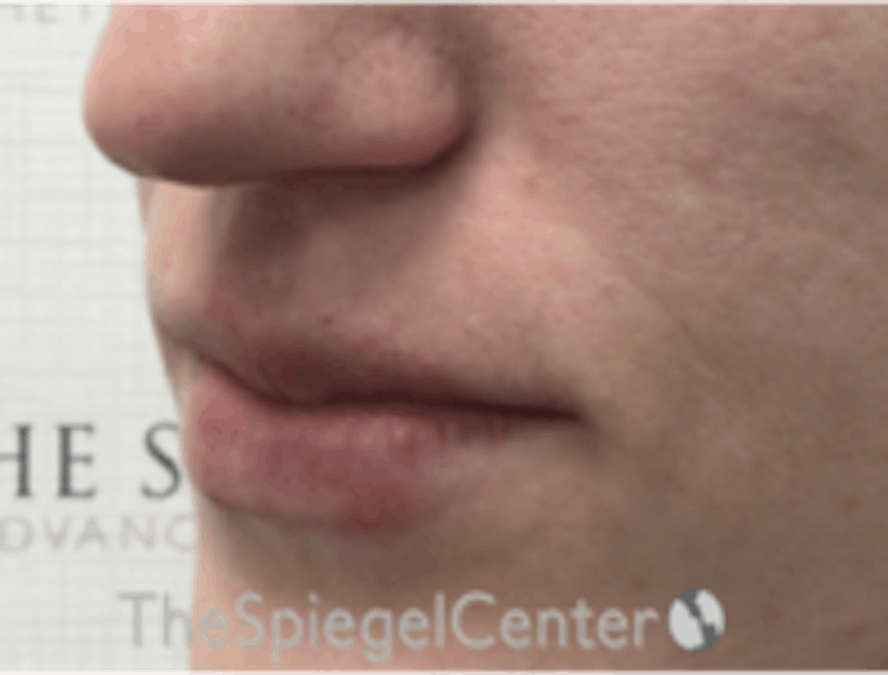 Lip Filler Before & After Gallery - Patient 157140582 - Image 6