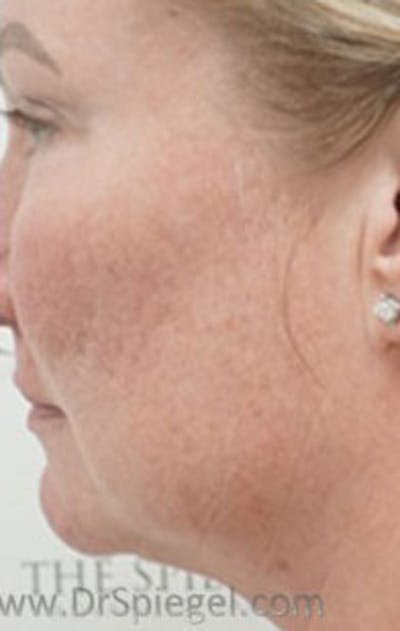 Morpheus8 Before & After Gallery - Patient 157140587 - Image 1