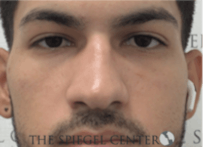Non-Surgical Rhinoplasty / Nose Filler Before & After Gallery - Patient 157140593 - Image 1