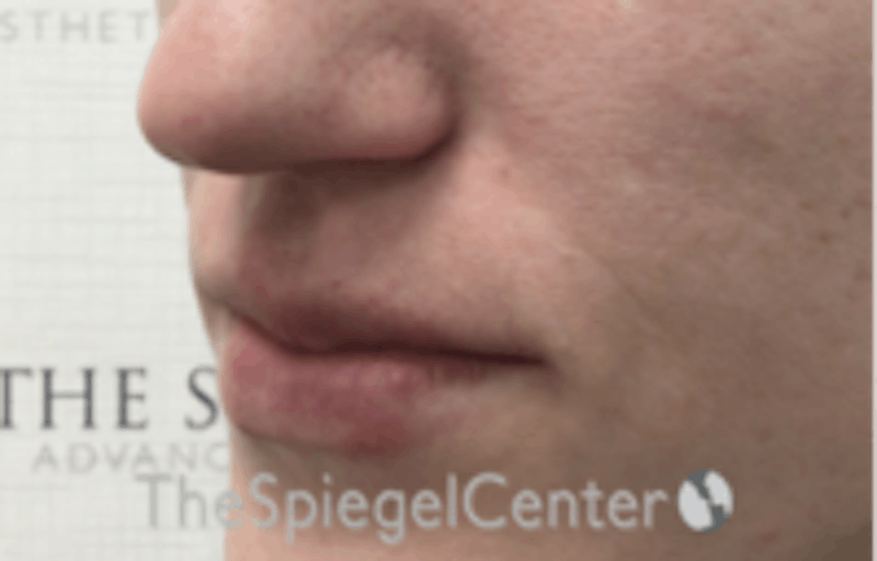 Nasolabial Fold Filler Before & After Gallery - Patient 157140585 - Image 4