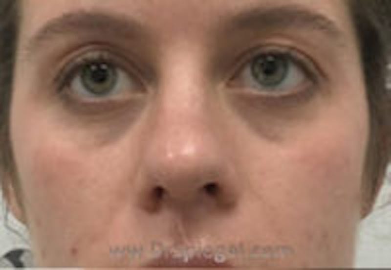 Tear Trough / Under Eye Fillers Before & After Gallery - Patient 157140588 - Image 1