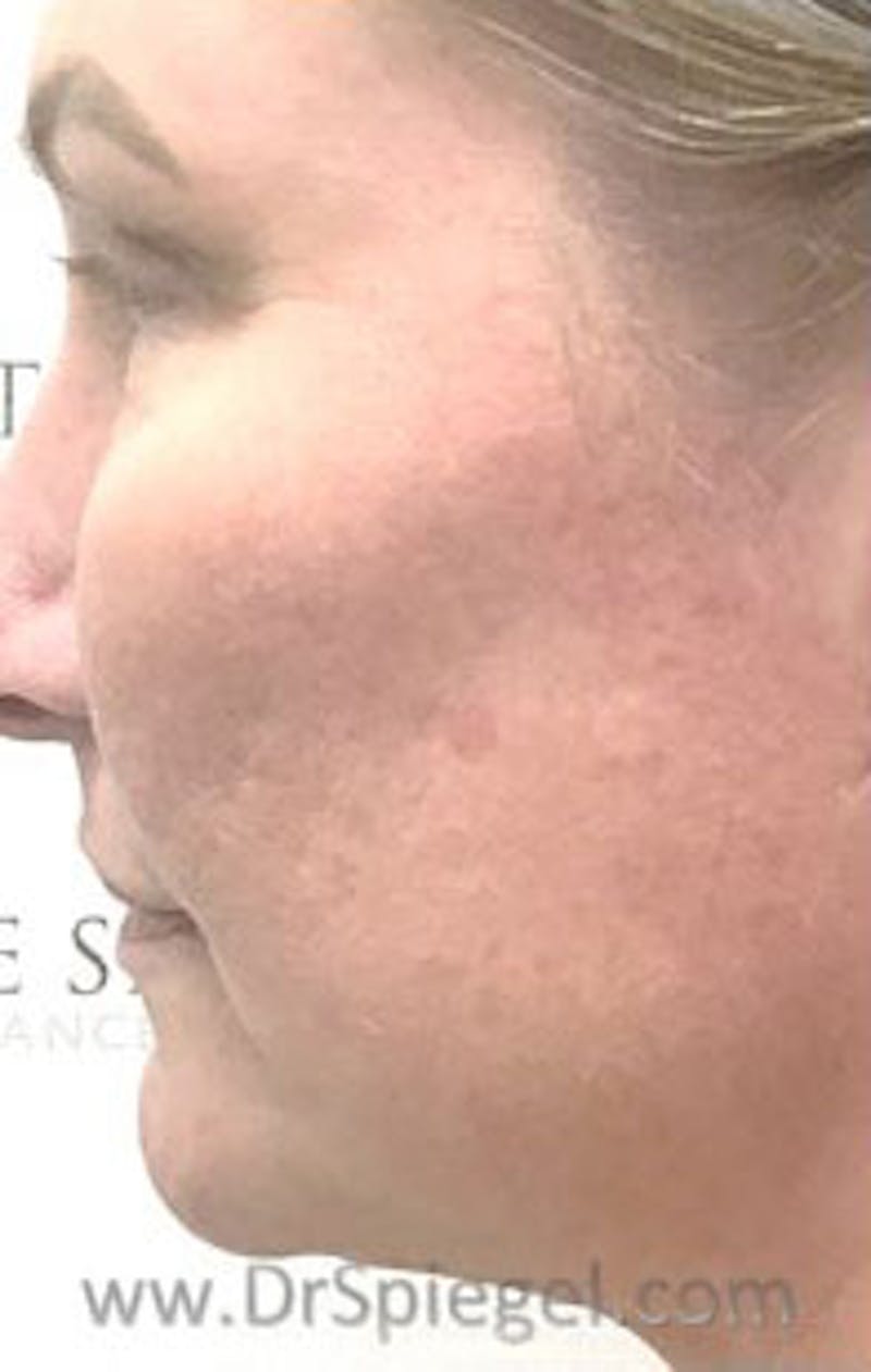 Morpheus8 Before & After Gallery - Patient 157140587 - Image 2