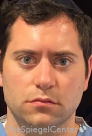 Botox / Dysport / Jeuveau / Xeomin Before & After Gallery - Patient 157140594 - Image 2