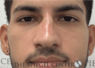 Non-Surgical Rhinoplasty / Nose Filler Before & After Gallery - Patient 157140593 - Image 2