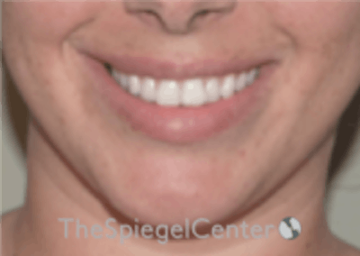 Lip Filler Before & After Gallery - Patient 157140601 - Image 1