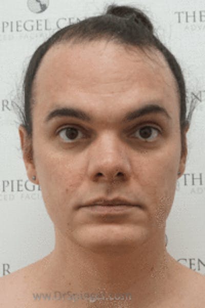 Hair Restoration Before & After Gallery - Patient 157140596 - Image 1