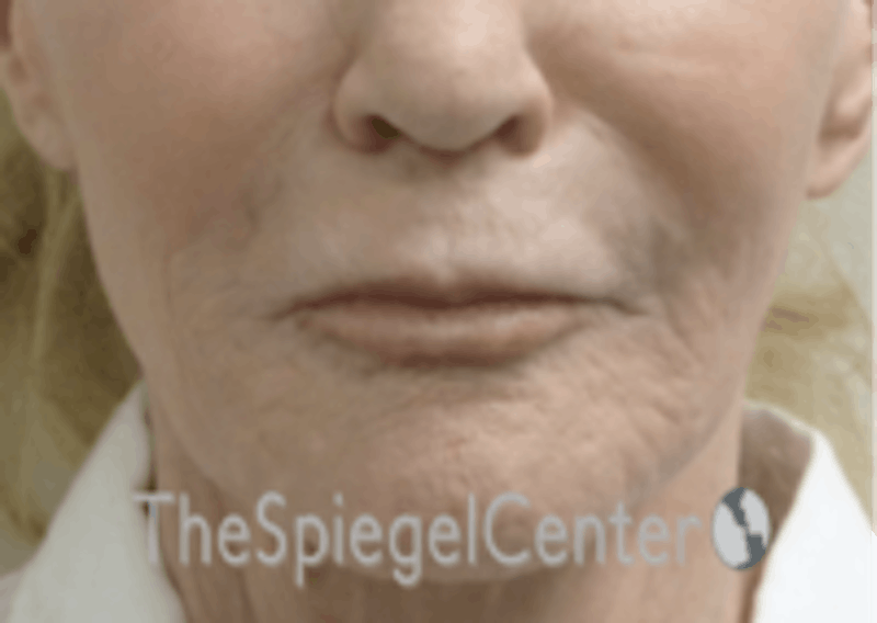 Nasolabial Fold Filler Before & After Gallery - Patient 157140597 - Image 1