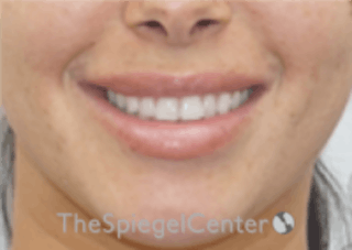 Lip Filler Before & After Gallery - Patient 157140601 - Image 2