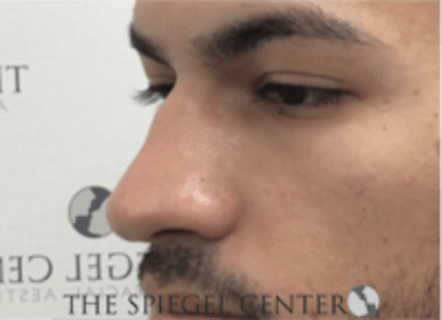 Non-Surgical Rhinoplasty / Nose Filler Before & After Gallery - Patient 157140593 - Image 3