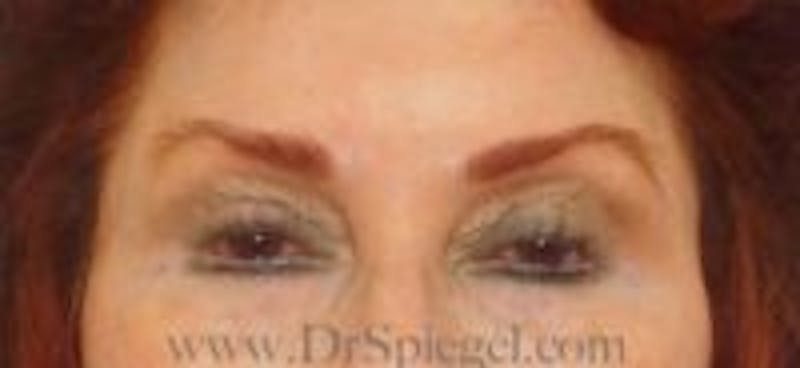 Temple Filler Before & After Gallery - Patient 157140591 - Image 1