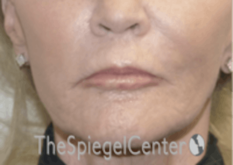 Nasolabial Fold Filler Before & After Gallery - Patient 157140597 - Image 2