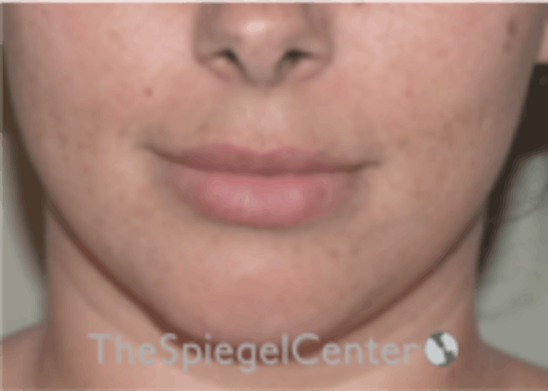 Lip Filler Before & After Gallery - Patient 157140601 - Image 3
