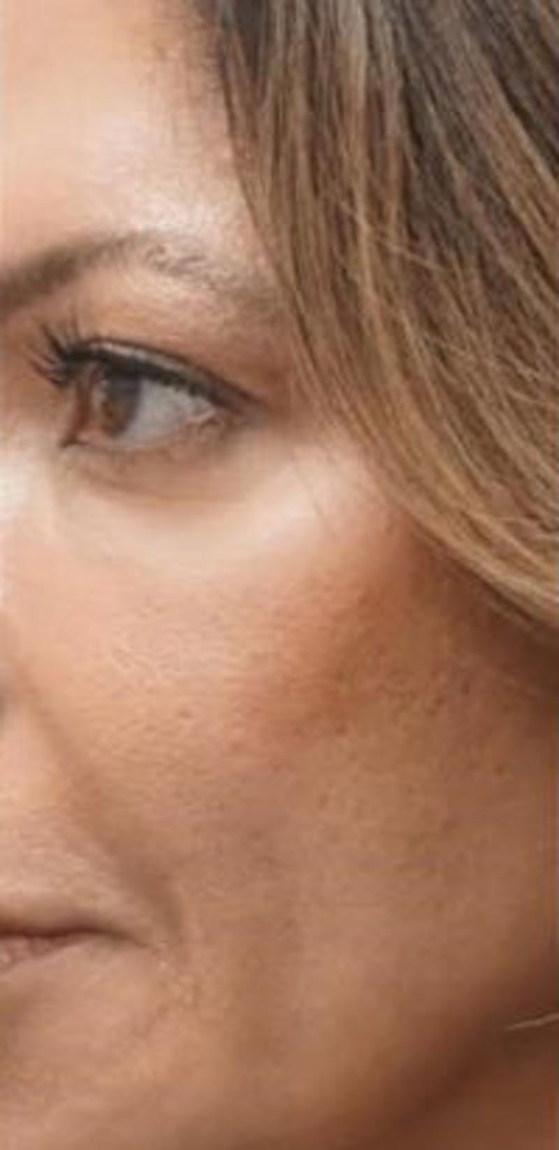 Morpheus8 Before & After Gallery - Patient 157140589 - Image 2