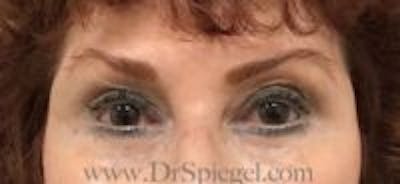 Temple Filler Before & After Gallery - Patient 157140591 - Image 2