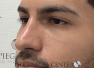 Non-Surgical Rhinoplasty / Nose Filler Before & After Gallery - Patient 157140593 - Image 4
