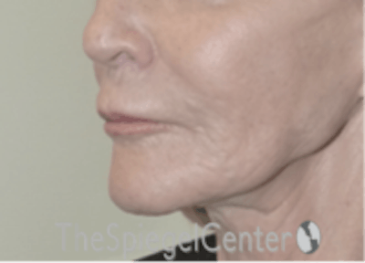 Nasolabial Fold Filler Before & After Gallery - Patient 157140597 - Image 3