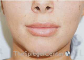 Lip Filler Before & After Gallery - Patient 157140601 - Image 4