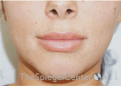 Lip Filler Before & After Gallery - Patient 157140601 - Image 4