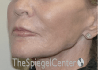 Nasolabial Fold Filler Before & After Gallery - Patient 157140597 - Image 4
