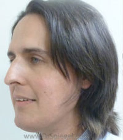 Scalp Advancement Before & After Gallery - Patient 157140600 - Image 1