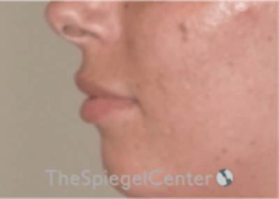 Lip Filler Before & After Gallery - Patient 157140601 - Image 5