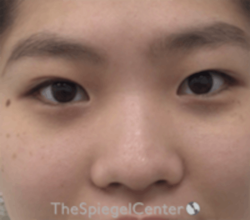 Non-Surgical Rhinoplasty / Nose Filler Before & After Gallery - Patient 157140607 - Image 1