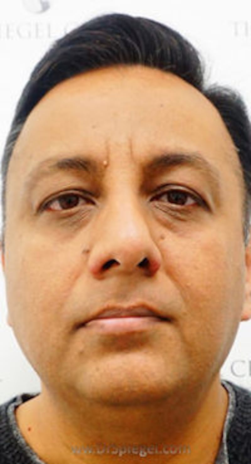 Botox / Dysport / Jeuveau / Xeomin Before & After Gallery - Patient 157140609 - Image 1
