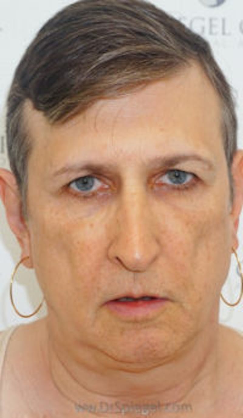 FFS Before & After Gallery - Patient 157140610 - Image 1