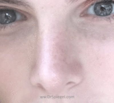 Rhinoplasty Before & After Gallery - Patient 157140599 - Image 2