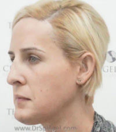 Scalp Advancement Before & After Gallery - Patient 157140600 - Image 2
