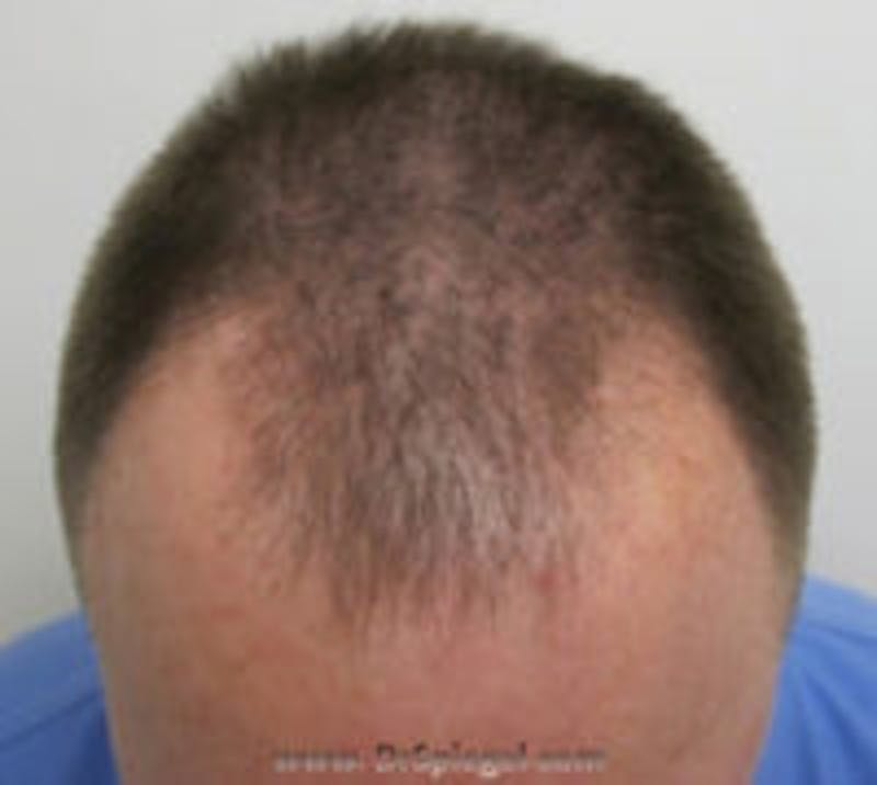 Hair Restoration Before & After Gallery - Patient 157140603 - Image 1