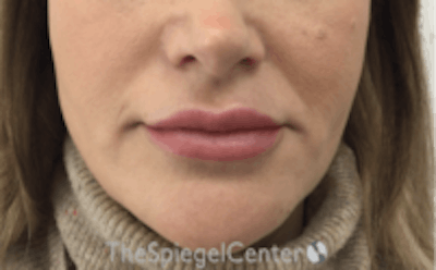 Nasolabial Fold Filler Before & After Gallery - Patient 157140613 - Image 1