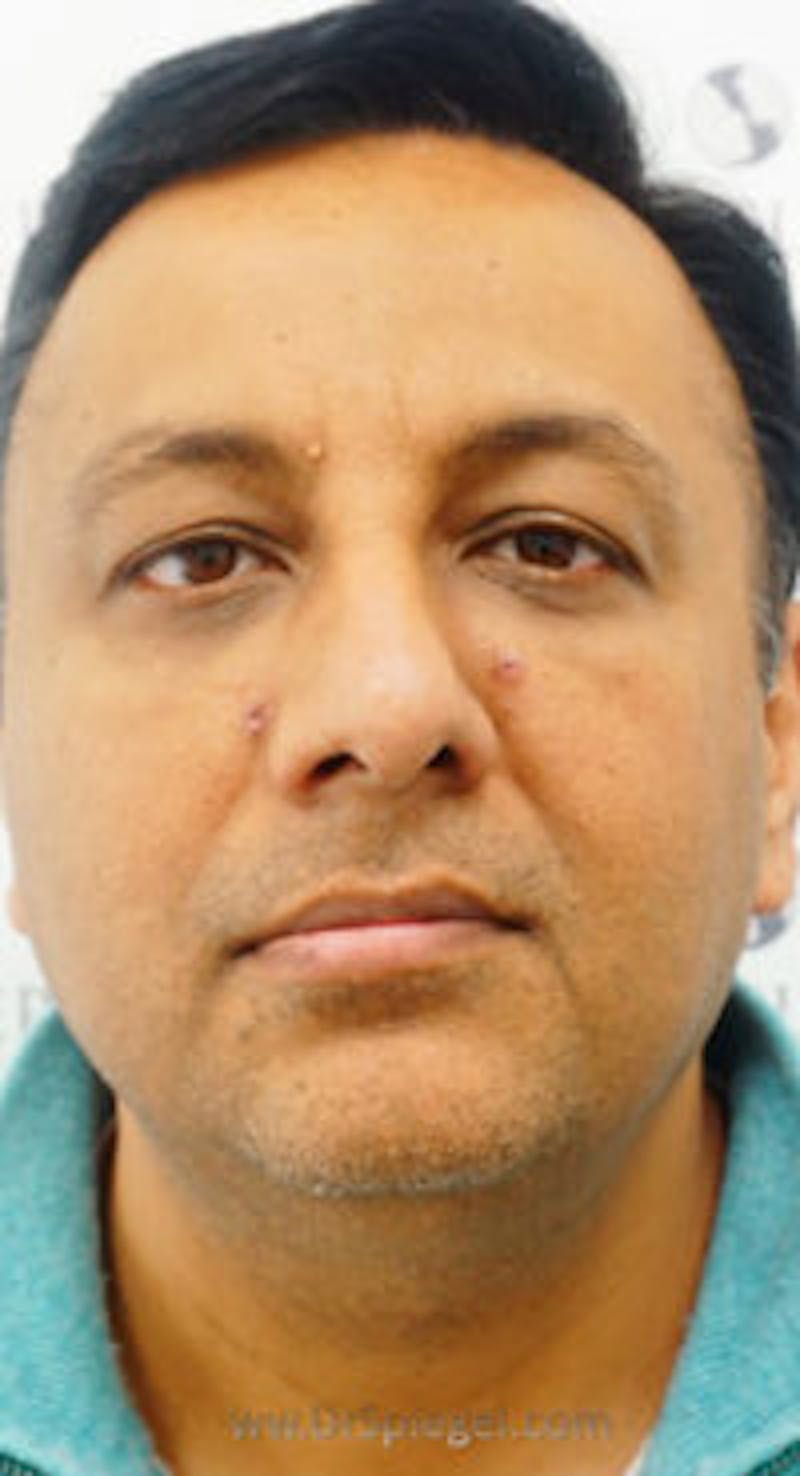 Botox / Dysport / Jeuveau / Xeomin Before & After Gallery - Patient 157140609 - Image 2