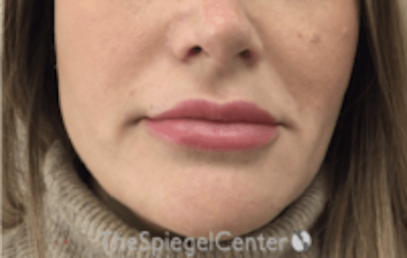 Nasolabial Fold Filler Before & After Gallery - Patient 157140613 - Image 2
