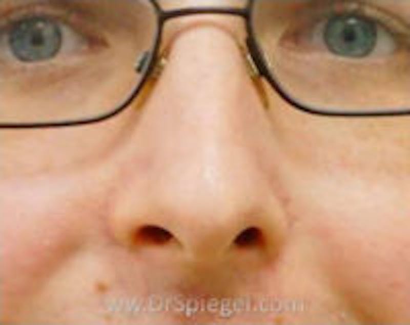Rhinoplasty Before & After Gallery - Patient 157140605 - Image 1