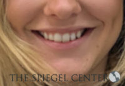 Lip Filler Before & After Gallery - Patient 157140619 - Image 1