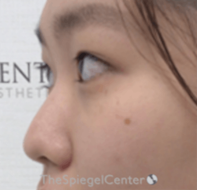 Non-Surgical Rhinoplasty / Nose Filler Before & After Gallery - Patient 157140607 - Image 3
