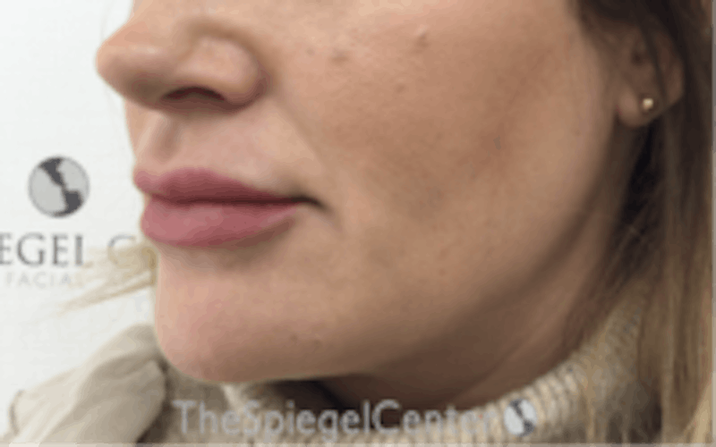 Nasolabial Fold Filler Before & After Gallery - Patient 157140613 - Image 3