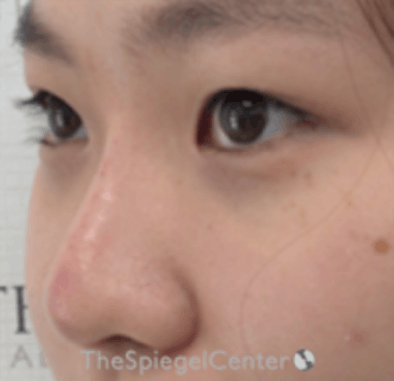 Non-Surgical Rhinoplasty / Nose Filler Before & After Gallery - Patient 157140607 - Image 4