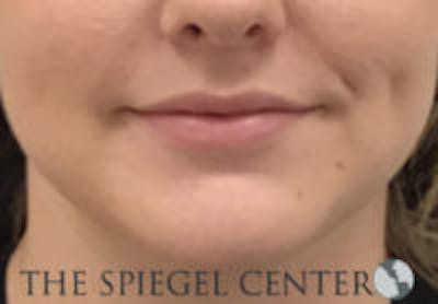 Lip Filler Before & After Gallery - Patient 157140619 - Image 3