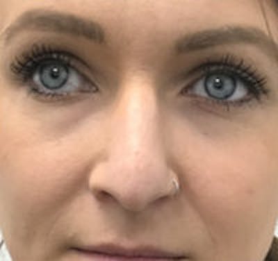 Non-Surgical Rhinoplasty / Nose Filler Before & After Gallery - Patient 157140618 - Image 1