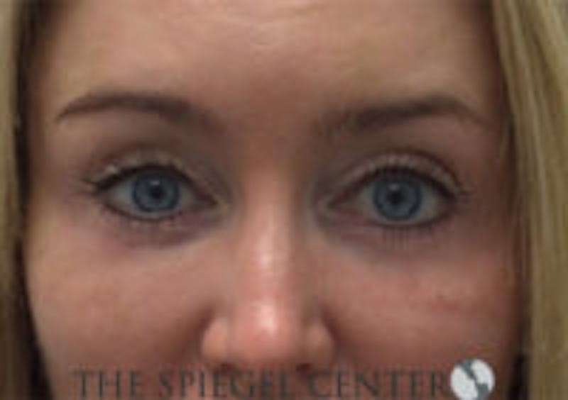 Tear Trough / Under Eye Fillers Before & After Gallery - Patient 157140616 - Image 2