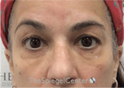 Temple Filler Before & After Gallery - Patient 157140615 - Image 1
