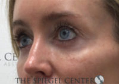 Tear Trough / Under Eye Fillers Before & After Gallery - Patient 157140616 - Image 3